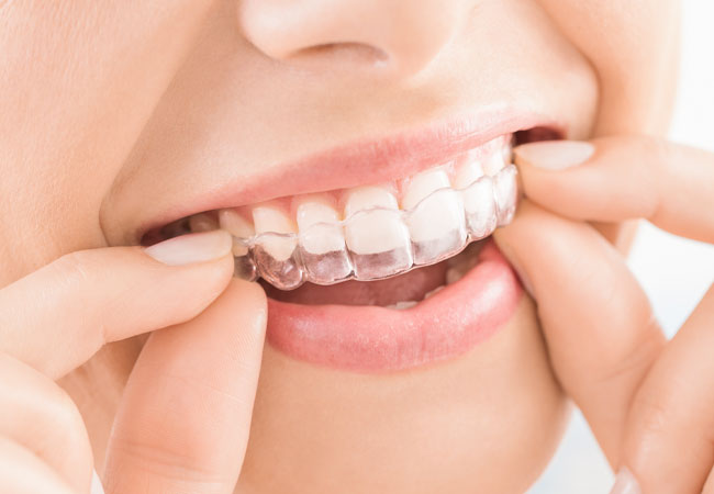 マウスピース矯正